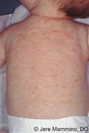 Image result for scabies human bites