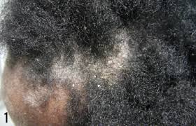 A severe lupus flare can result in fragile hair that breaks easily. Can You Spot The Cause Of This Girl S Scalp Lesion And Body Rash Consultant360