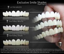 Our clip on veneers do not look like clip on veneers, they look like real veneers. Presson Veneers Brighter Image Lab Official Site Bil Veneers Dental Veneers Veneers Teeth Perfect Teeth