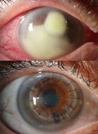 Image result for Keratitis