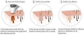 Reprezentarea grafică a funcției de gradul ii 2021, aprilie. Ce Este Epilarea Cu Laser Dioda Institut Dana Beauty Facebook
