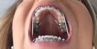 Pin On Cute Braces