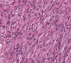 Bap1 is a tumour suppressor gene commonly mutated in mm. Highlights Of The 14th International Mesothelioma Interest Group Meeting Pathologic Separation Of Benign From Malignant Mesothelial Proliferations And Histologic Molecular Analysis Of Malignant Mesothelioma Subtypes Lung Cancer