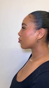 Pixie Nose Tip Before After