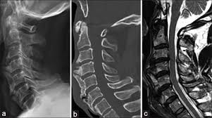 These ligaments connect the individual bones together, and they help form the intervertebral joints. Surgical Management Of Symptomatic Ossified Anterior Longitudinal Ligament A Case Report Surgical Neurology International