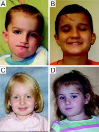 Speech delay and autism spectrum behaviors are frequently associated with  duplication of the 7q11.23 Williams-Beuren syndrome region