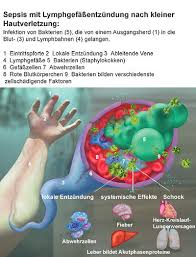 Every year, at least 1.7 million adults in america develop an extreme response to infection, a condition called sepsis that kills nearly 270,000 as a result. Blutvergiftung Aus Dem Ruder