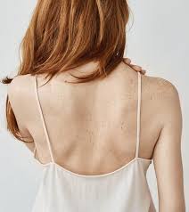 How does hand sanitizer work? How To Get Rid Of Tinea Versicolor Symptoms Causes And Diet Tips
