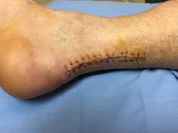 Check spelling or type a new query. Achilles Tendon Treatments Back Of Heel Pain Pittsburgh Beaver Valley Foot Clinic