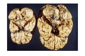 Fetal Alcohol Spectrum Disorders Clinical Advisor