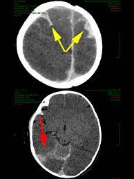 Report To The Prosecutor In Cases Of Shaken Baby Syndrome Abusive Head Trauma Still An Ongoing Debate