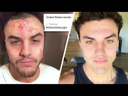 My Struggle With Acne and Self Confidence