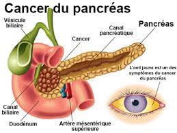 Quels espoirs contre le cancer du pancr�as ? Cancer Du Pancreas Symptomes Traitement Definition Docteurclic Com