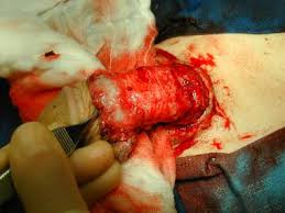 Résultat de recherche d'images pour "penis degloved"