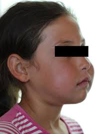 Through the influence of the septuagint, cherubim was used in the earlier english versions, also as a singular, hence, the plural was made to sound cherubims. Cherubism Springerlink