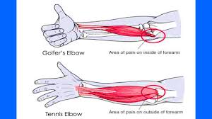 Despite its name, tennis elbow doesn't only affect tennis players. Fyzical Forest Grove Four Simple Tips For Tennis Elbow