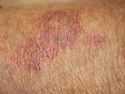 What are the treatments for idiopathic thrombocytopenic purpura (itp)? Senile Purpura Dermnet Nz