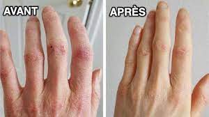 Combiner ce remède de grand mère pour maigrir avec un régime léger (fruits, légumes, viandes et poissons grillés, produits laitiers faibles en matières grasses et de petites quantités de pain et filtrer et boire une tasse par jour. 6 Remedes De Grand Mere Pour Dire Adieu Aux Mains Seches Et Abimees