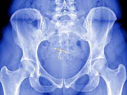 Unusual bleeding a lot of. Iud Complications Ob Gyns Discuss Expulsion And Perforation Self