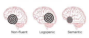Primary progressive aphasia (ppa) is a neurological syndrome in which language capabilities become slowly and progressively impaired. Alcune Demenze Influenzano Soprattutto Parola E Linguaggio