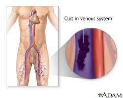 Deep Vein Thrombosis Edmonton Journal