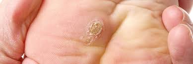 This effectively suffocates the virus, causing the gradual death and shedding of the infected skin cells. Verrutop Verruca Treatment A New Treatment For Verruca