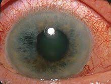 This damage is often caused by an abnormally high pressure in your eye. Glaucoma Wikipedia