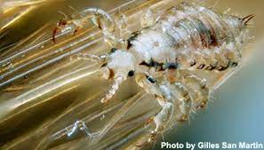 Removing Head Lice Eggs With Ordinary Conditioner Is Just As Effective As  Using Special Products