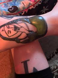 It's unlikely that your tattoo will be. The Biggest Blister I Ve Ever Had First Laser Treatment And I M Laughing At How Big This Bad Boi Is Tattooremoval