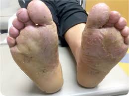 Image result for pompholyx soles of feet
