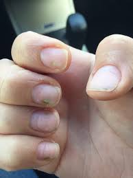 With dots, you can create a simple manicure peas and other green. Acrylic Nails And Fungus