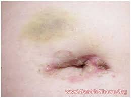 What is vertical sleeve gastrectomy? Single Incision Gastric Sleeve In Puerto Vallarta Sils Vsg Gastric Sleeve Surgery