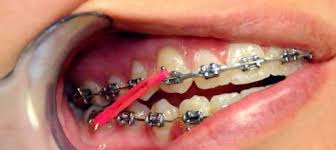 Kemaskini bagi sistem pendaftaran pekerjaan spa9 akan dilakukan dari semasa ke semasa. Pakai Braces Akhirnya
