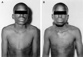 Oct 01, 2020 · q67.6 pectus excavatum. Pectus Carinatum Thoracic Surgery Clinics