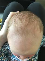When hair is overprocessed, explains moodie, it will generally snap off and break due to hair being damaged by the chemicals for too long. Baby Hair Loss My Daughter Looks Like A 80 Year Old Man August 2019 Babies Forums What To Expect