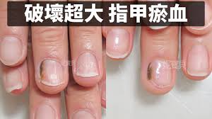 指甲瘀青瘀血 熱愛拳擊破壞大的矯正案例 強烈運動傷害的手指 途中還不幸發霉 nails