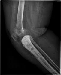 How metastases form new tumors. Unusual Sites Of Metastases Of Carcinoma Cervix Bmj Case Reports