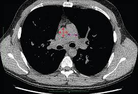 Formerly known as cystic fibrosis of the pancreas, this entity has increasingly been labeled simply cystic fibrosis. Supplemental Materials For Pulmonary Artery Enlargement And Cystic Fibrosis Pulmonary Exacerbations A Cohort Study The Lancet Respiratory Medicine
