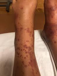 It is also known as bateman purpura, after british dermatology pioneer thomas bateman, who first described it in 1818; Henoch Schonlein Purpura In The Adult Jetem