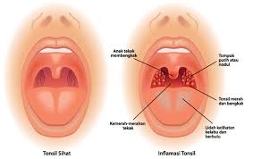 Selain menthol, ia juga tinggi sebatian antiradang, antibakteria dan antiviral yang sangat bagus untuk merawat ketidaknormalan pada tekak. Anak Tekak In English Layerofprotection Instagram Posts Photos And Videos Picuki Com Fever Colds Cough Sore Throat
