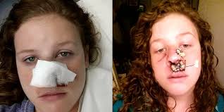 Although it is the most commonly diagnosed cancer in american women, breast cancer can impact people of all genders. Marisha Dotson Shares Photos After Pimple Turns Out To Be Skin Cancer The Mighty