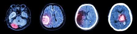 Image result for Brain Lesion