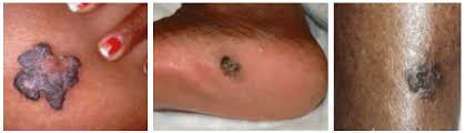 Lymphoma can appear in different areas of the body, including the skin. Skin Cancer In People Of Color