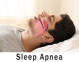 Image result for Sleep Apnea