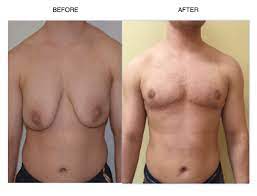 This may or may not include consultation fees. Dr Gallagher On Ftm Top Surgery Ftm Double Incision Keyhole Surgery Lesbian Adventures In Love