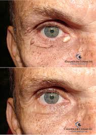 They generally do not cause pain unless rubbed frequently or twisted, and are not a medical threat. Mole Removal Philadelphia Mole Removal Main Line Skin Tag Removal