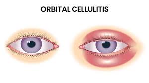 Image result for Cellulitis