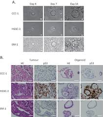 Ovarian cancer can develop on the surface of the ovary or from tissues inside the ovary. Patient Derived Ovarian Cancer Organoids Capture The Genomic Profiles Of Primary Tumours Applicable For Drug Sensitivity And Resistance Testing Scientific Reports
