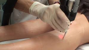 Toutes les zones peuvent être traitées. Prix De L Epilation Laser Centre Marceau Paris