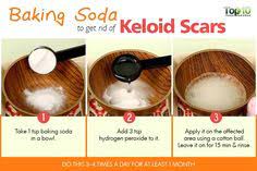How do i get rid of a keloid. Keloids